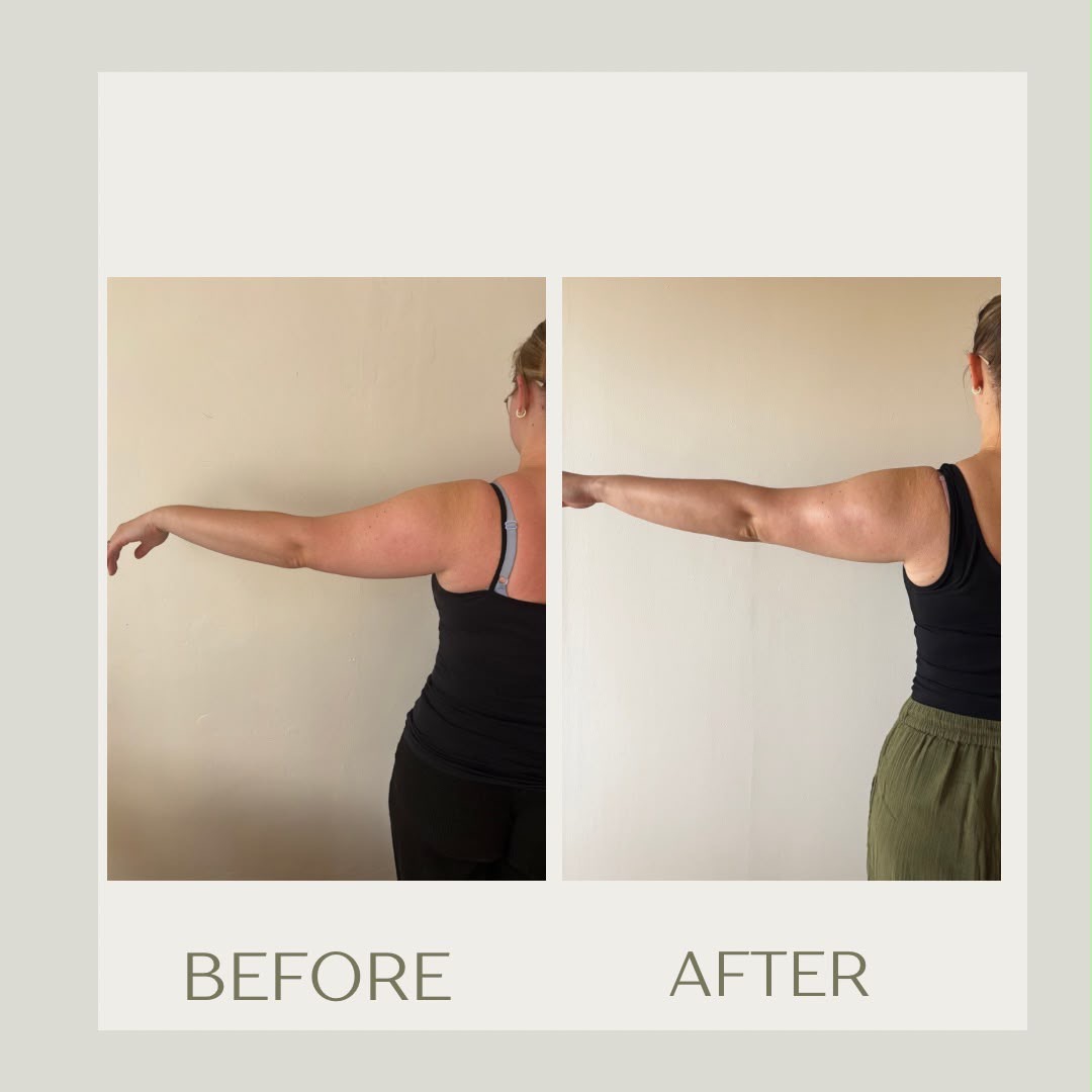 Upper arm sculpting before-and-after comparison