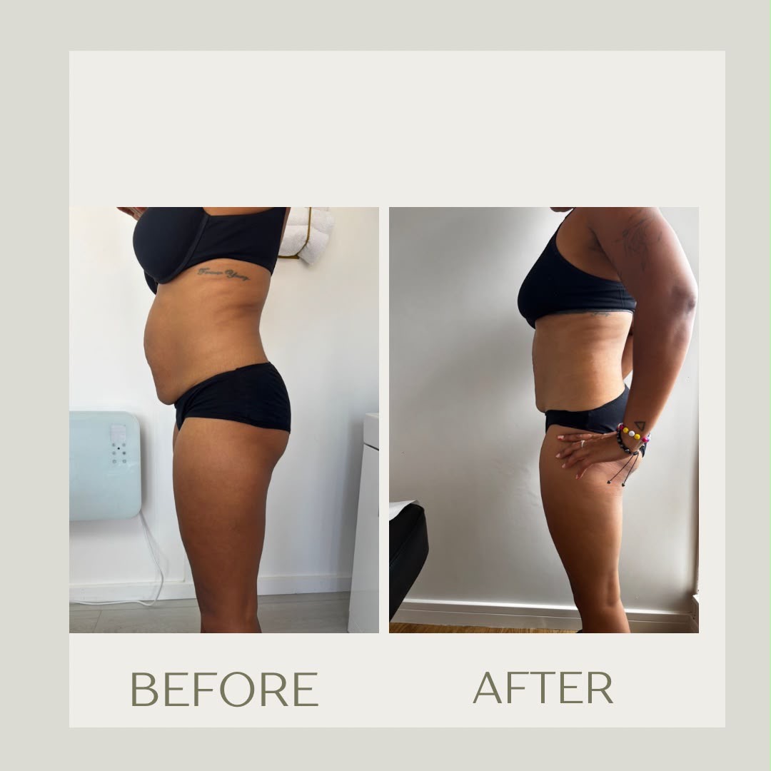 Body contouring before-and-after comparison, side view