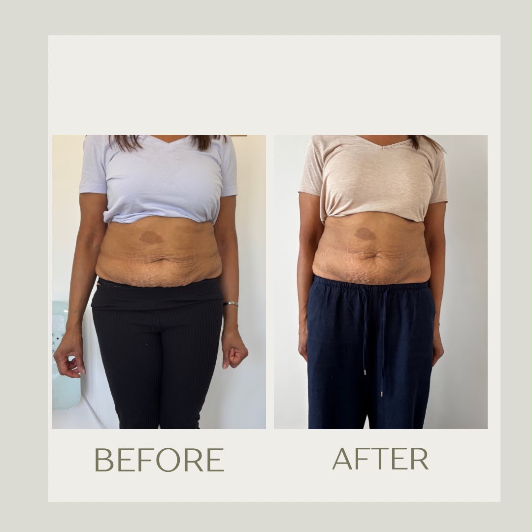 Tummy contouring before-and-after comparison
